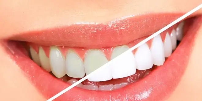 Best Implant Dentist In South Delhi